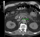 Abdominal aorta in CT image