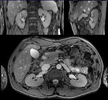 MRI of kidneys